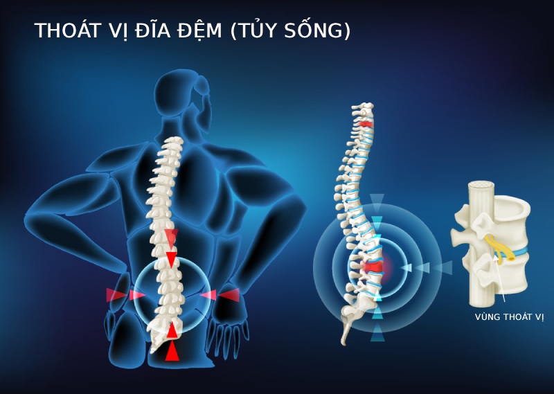 Nhân nhầy tràn ra ngoài gây thoát vị đĩa đệm
