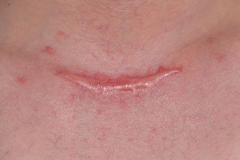 bôi dermatix gel 15g có dấu hiệu sẹo nặng hơn cần dừng gấp