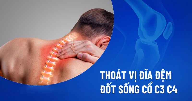 Thoát vị đĩa đệm đốt sống cổ c3 c4