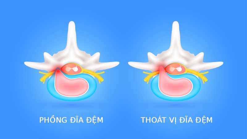 Thoát vị đĩa đệm xuất hiện do thoái hóa
