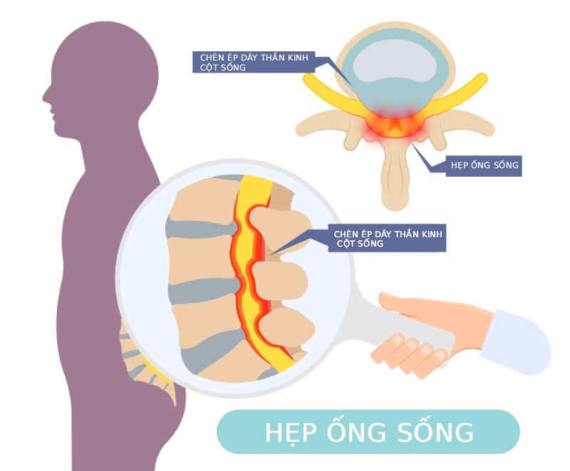 Tình trạng hẹp ống sống