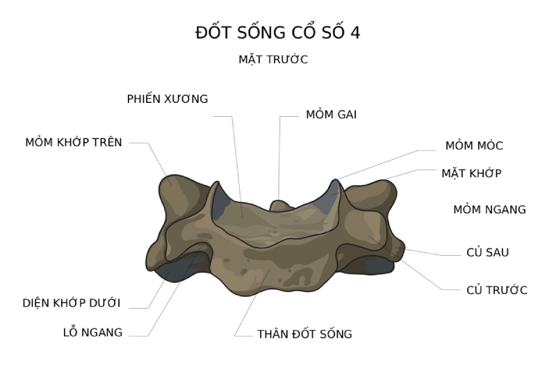 Tình trạng nhân nhầy đĩa đệm thoát ra ngoài