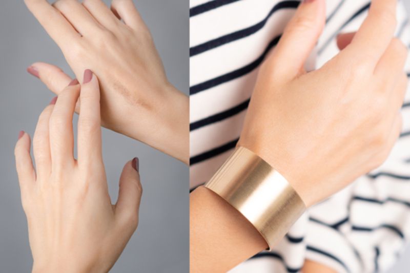 dermatix ultra 15g có tác dụng hỗ trợ xóa sẹo nhanh chóng