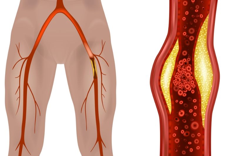 bệnh xơ động mạch ngoại biên