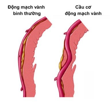 động mạch vành phải cấp máu cho nửa bên phải tim