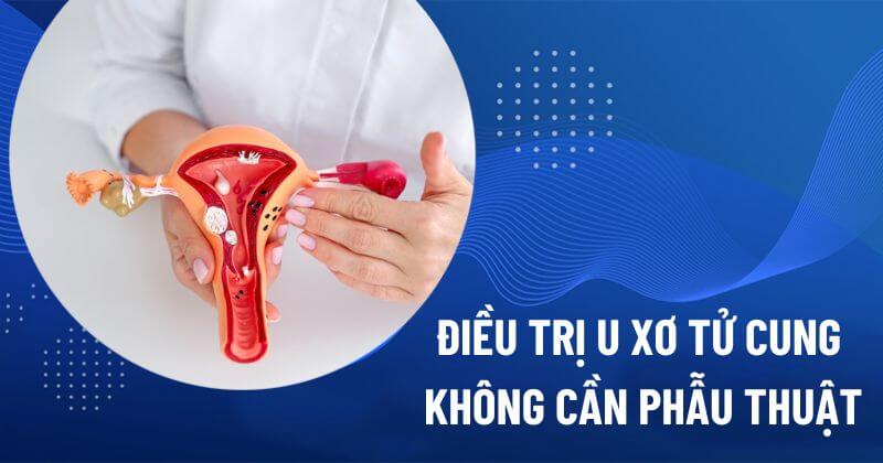 Điều trị u xơ tử cung không cần phẫu thuật