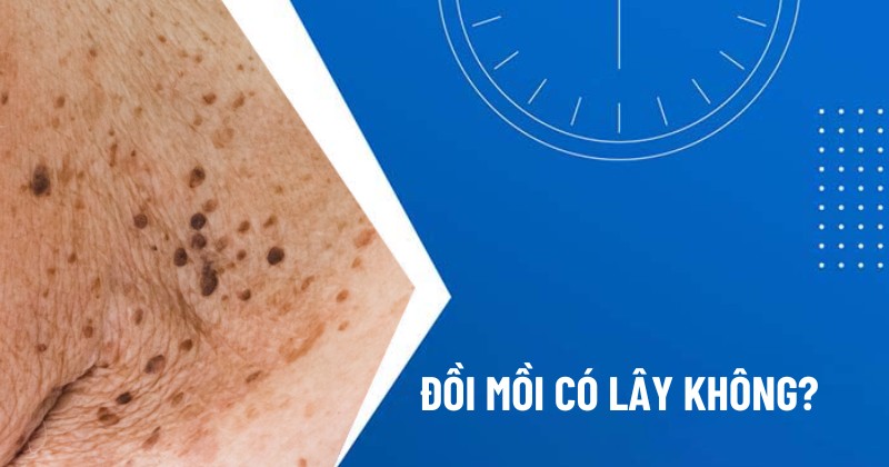 đồi mồi có lây không