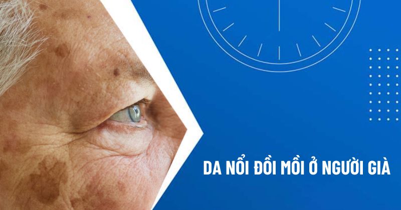 đồi mồi ở người già