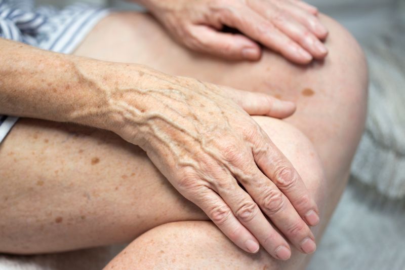 đồi mồi thường tập trung ở vùng mu bàn tay người già