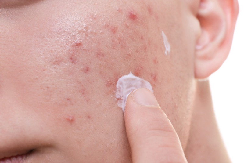 tác dụng của kem trị sẹo lõm