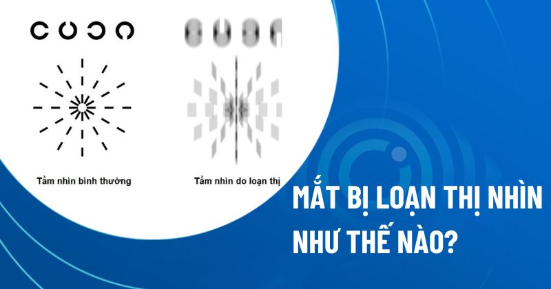 loạn thị nhìn như thế nào