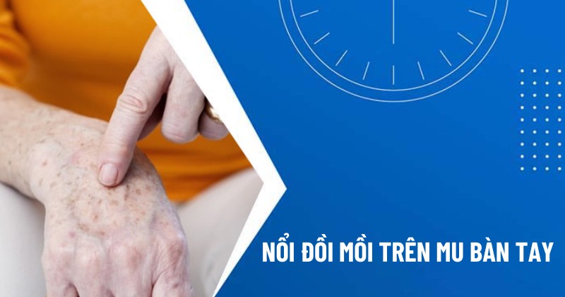 nổi đồi mồi trên mu bàn tay