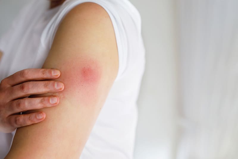 phản ứng tại chỗ tiêm có thể xảy ra