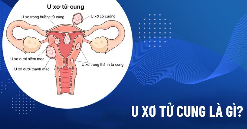 U xơ tử cung