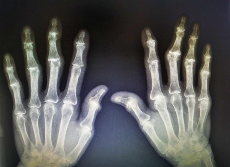 chẩn đoán viêm khớp dạng thấp bằng ảnh chụp x quang