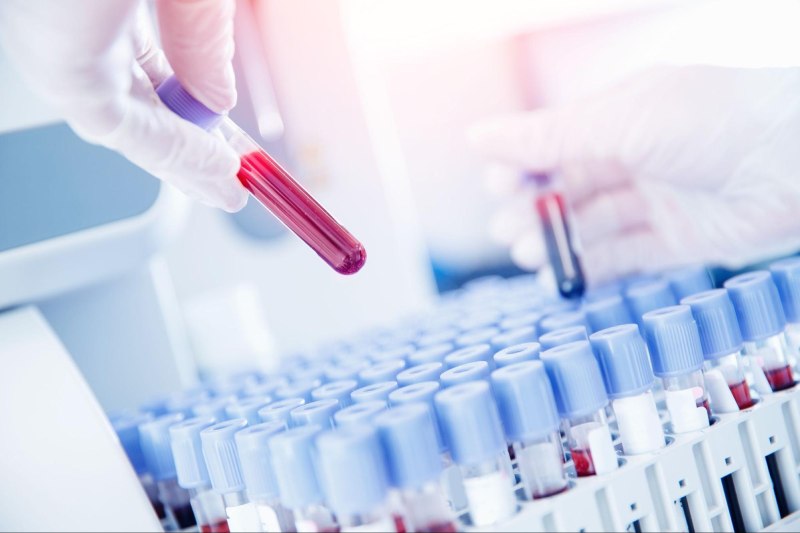 Xét nghiệm máu để kiểm tra nồng độ các loại hormone
