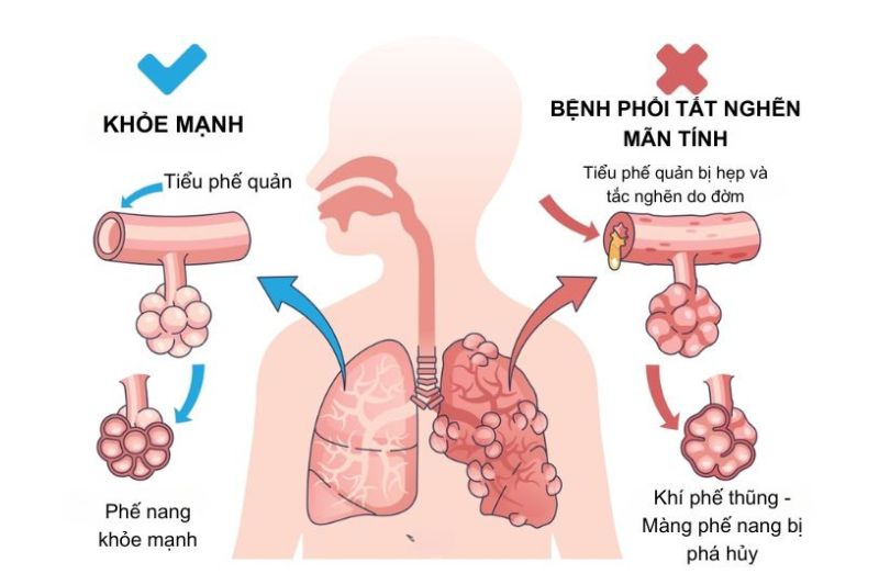 bệnh lý liên quan đến phổi