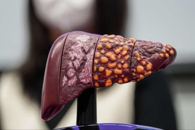 biến chứng viêm gan c type 6