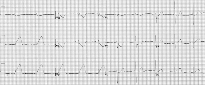 điện tâm đồ nhồi máu cơ tim thành dưới cấp tính