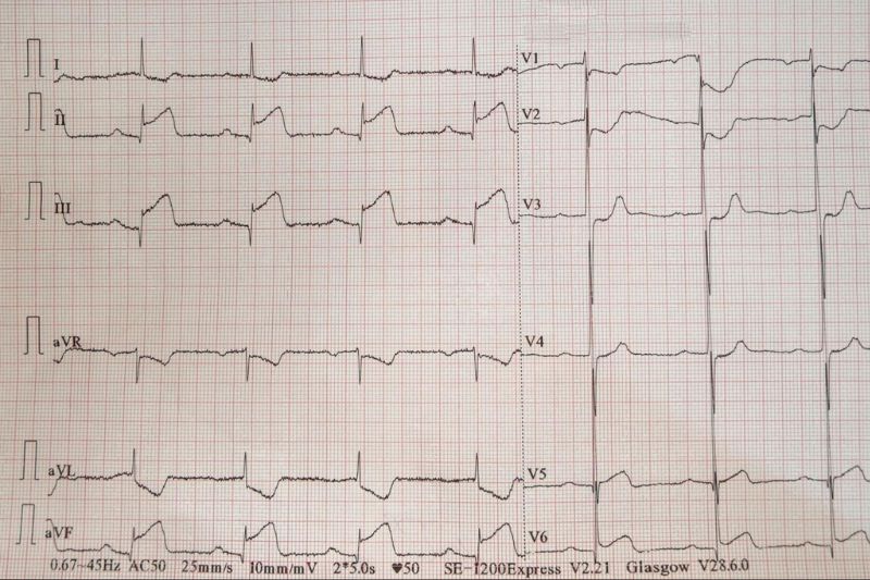 đoạn ST chênh lên ở hai chuyển đạo liên tiếp