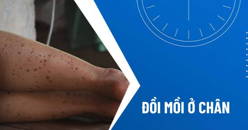 đồi mồi ở chân