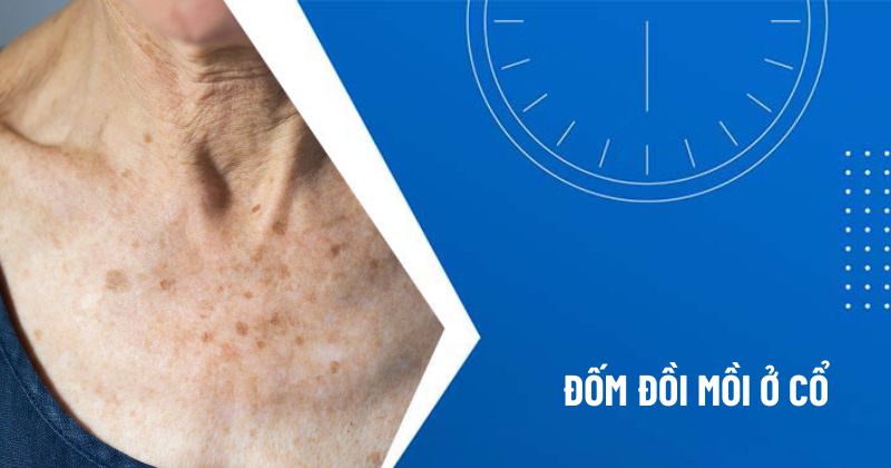 đồi mổi ở cổ