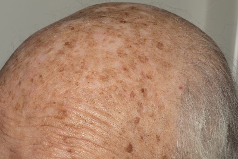 đồi mồi trên da đầu có dạng những đốm nâu hoặc nâu sẫm