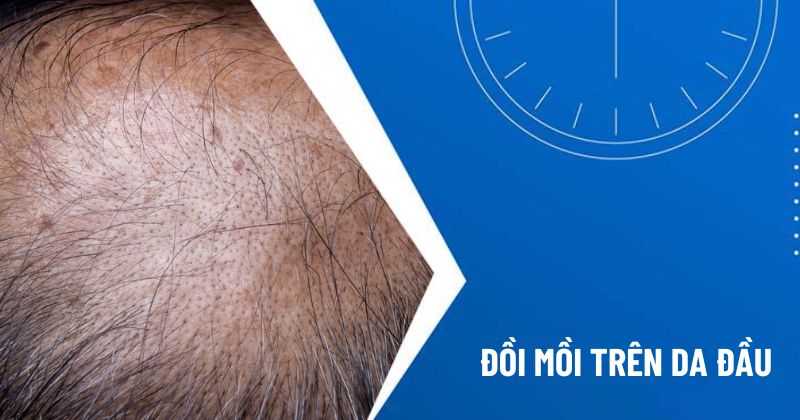 đồi mồi trên da đầu