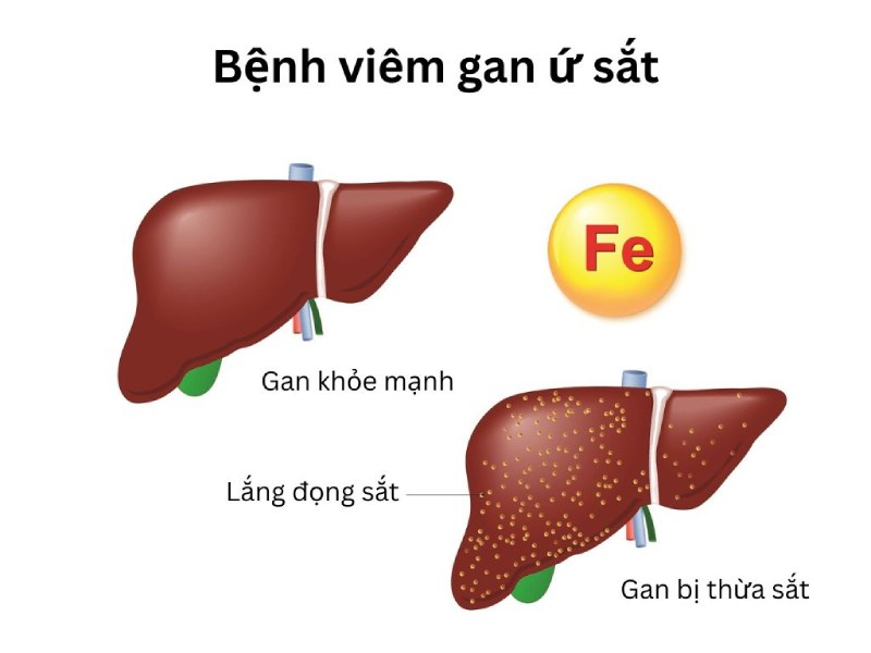 Hình ảnh gan bị lắng đọng sắt