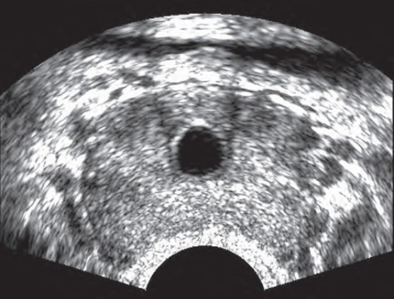 Hình ảnh siêu âm của nang tuyến tiền liệt