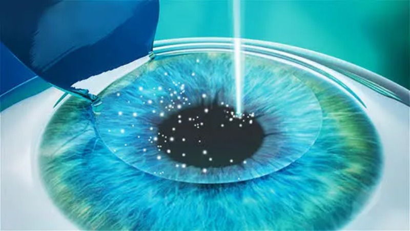 bước 3 phẫu thuật presbyond