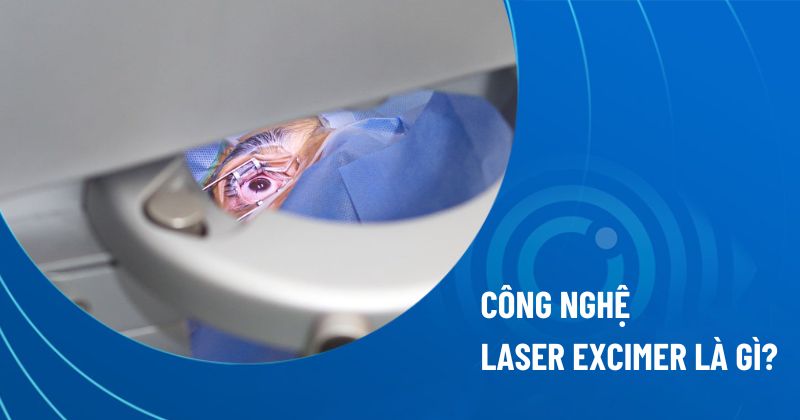 Laser excimer có vai trò thế nào trong mổ mắt khúc xạ?