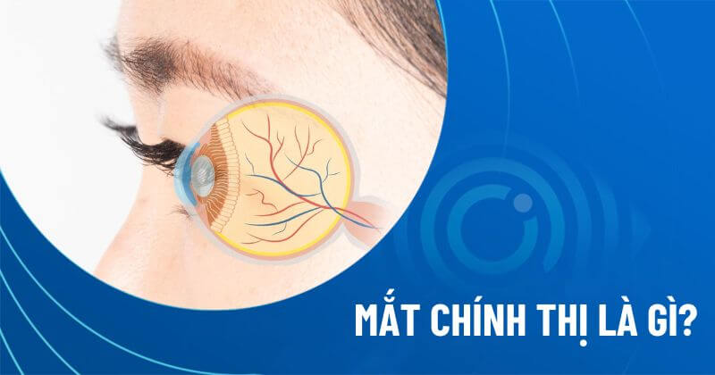 mắt chính thị là gì