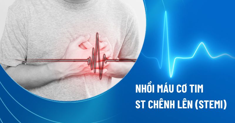 nhồi máu cơ tim st chênh lên