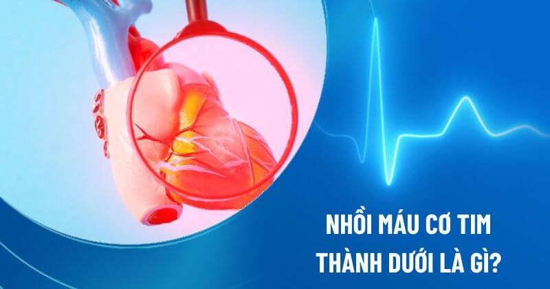 nhồi máu cơ tim thành dưới