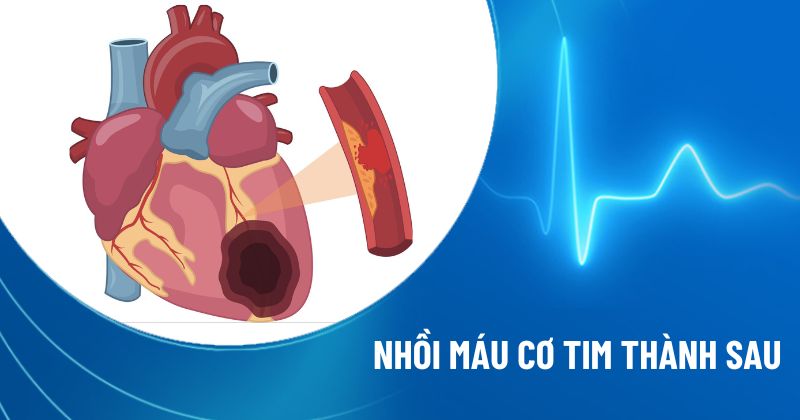 Nhồi máu cơ tim thành sau: “Kẻ giấu mặt” trên bản ghi điện tim