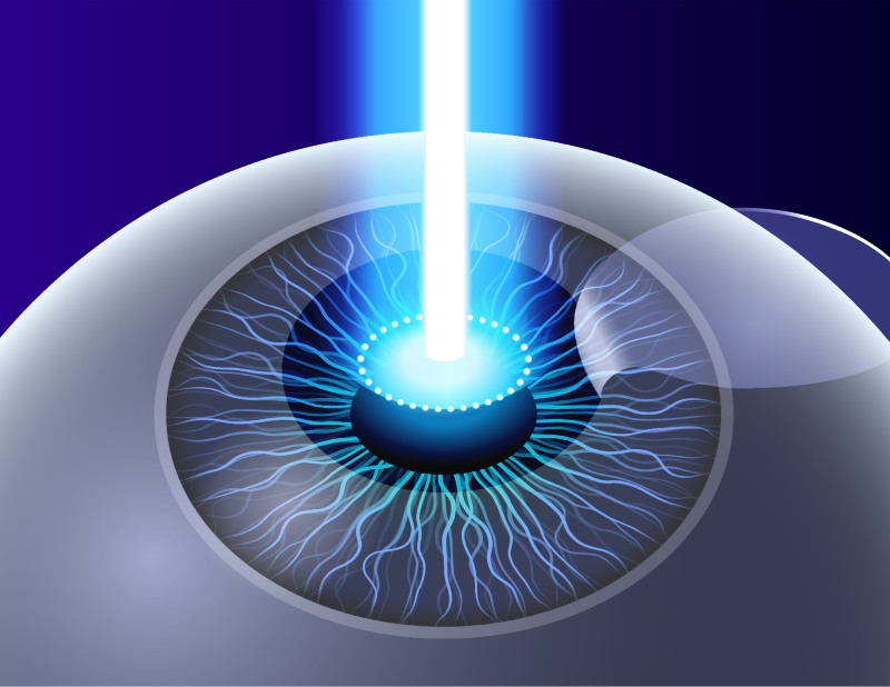 phậu thuật lasik thường phù hợp cho cả tật loạn thị và cận thị