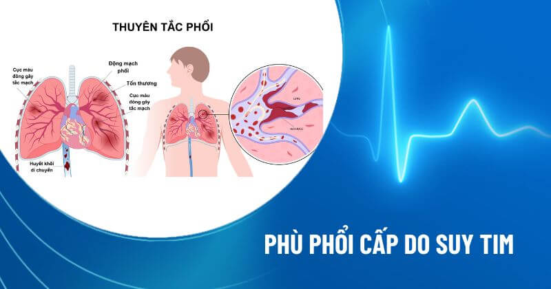 phù phổi cấp do suy tim