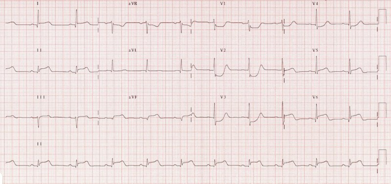 xuất hiện nhồi máu thành sau của sóng r