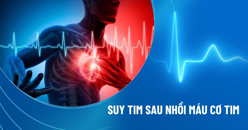 Tìm hiểu tình trạng suy tim sau nhồi máu cơ tim