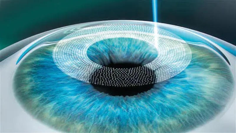 bước 1 phẫu thuật presbyond