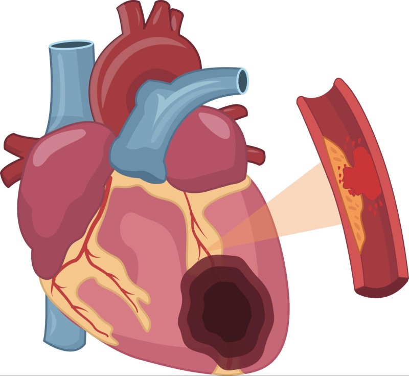 thiếu máu cục bộ cơ tim cấp tính làm giảm chức năng co bóp thất trái