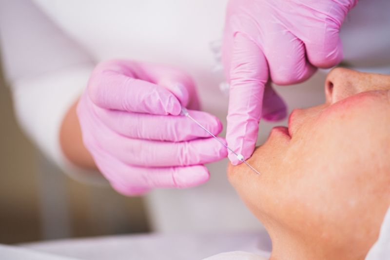 tiêm mesco làm mờ đốm sắc tố