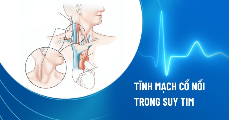 tĩnh mạch cổ nổi trong suy tim