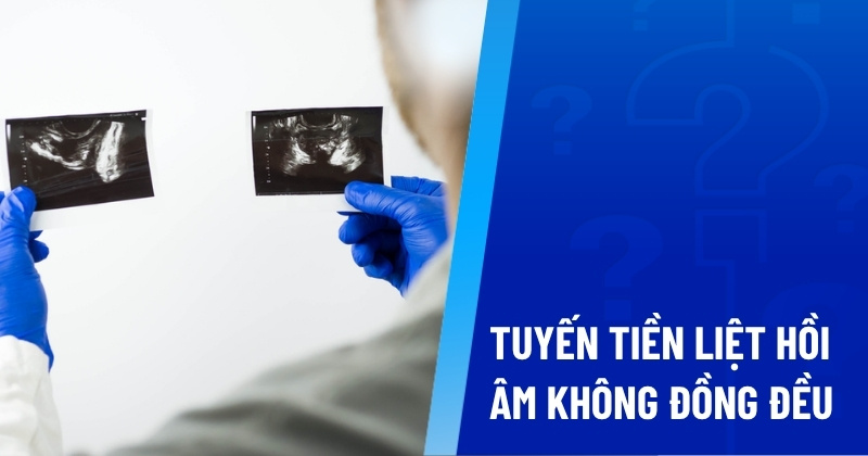tuyến tiền liệt hồi âm không đồng đều là gì