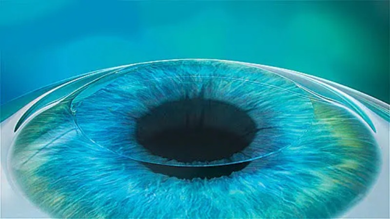 bước 4 phẫu thuật presbyond