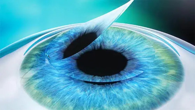 bước 2 phẫu thuật presbyond