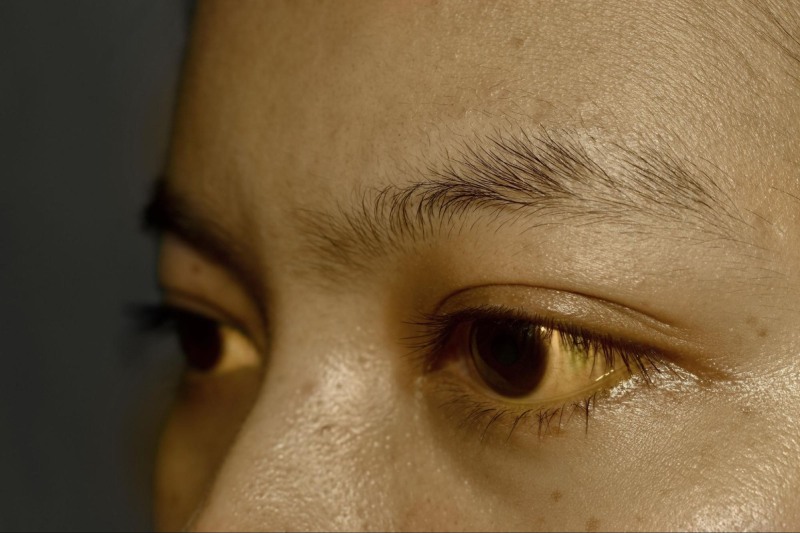 viêm gan b cấp tính gây vàng da vàng mắt