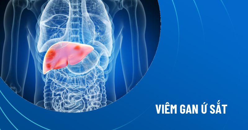 Viêm gan ứ sắt