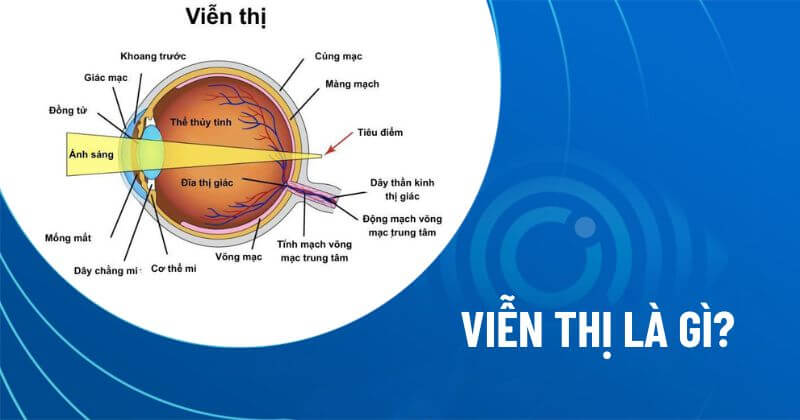 Viễn thị là gì? Nguyên nhân, dấu hiệu, chẩn đoán và điều trị